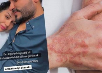 Dilan Polat ne hastası? Lupus hastalığı neden olur? Dilan Polat’ın kelebek hastalığı nedir?