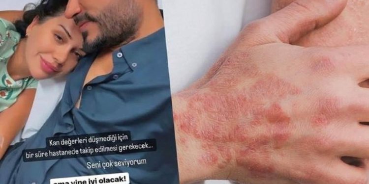 Dilan Polat ne hastası? Lupus hastalığı neden olur? Dilan Polat’ın kelebek hastalığı nedir?