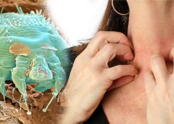 Uyuza karşı evde ne yapmalıyız? Dr. Feridun Kunak’tan uyuza karşı muhteşem karışım